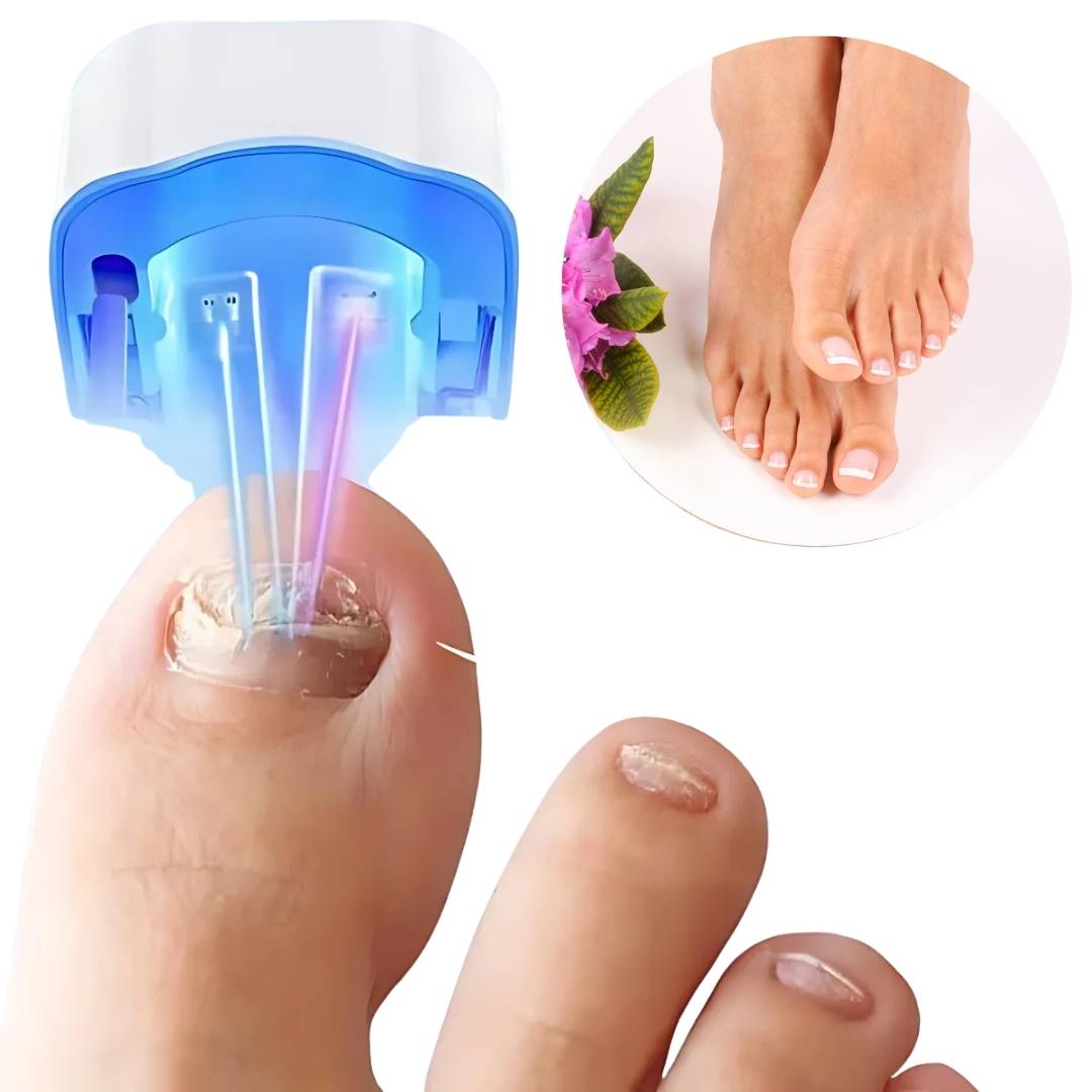 Dispositivo láser para hongos en las uñas - Indoloro y eficaz