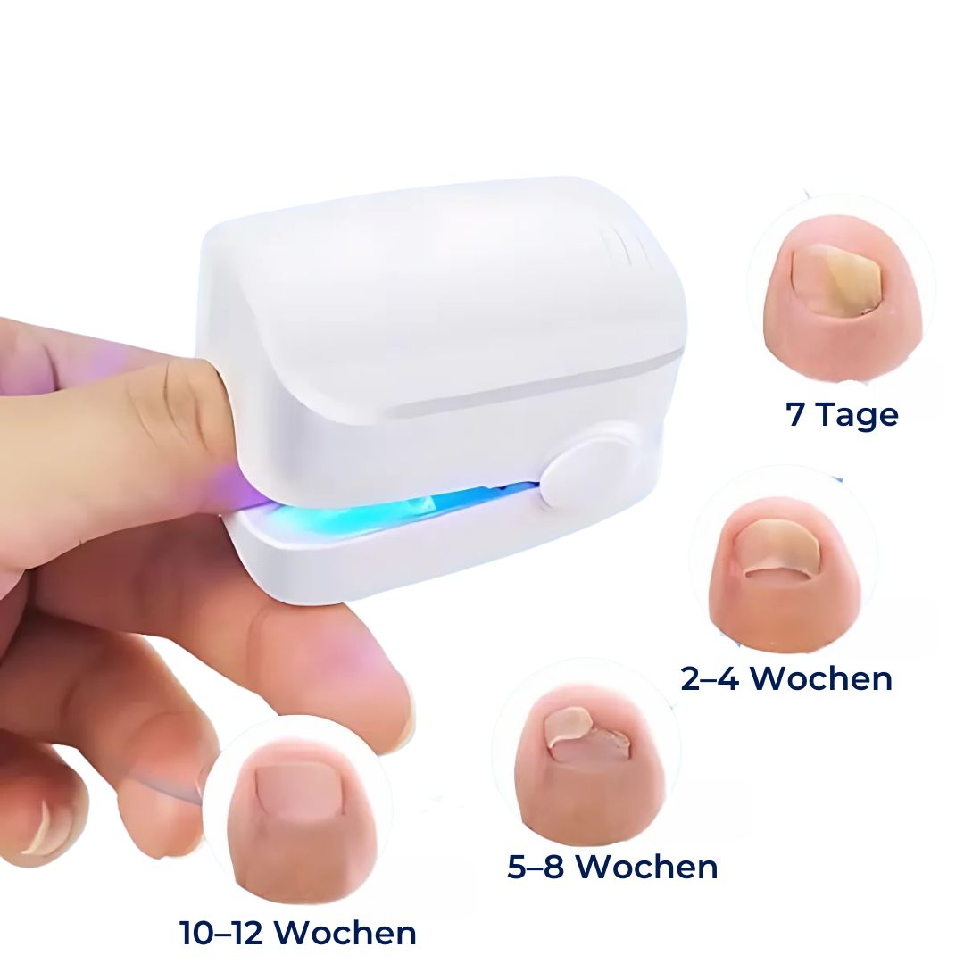 Dispositivo láser para hongos en las uñas - Indoloro y eficaz