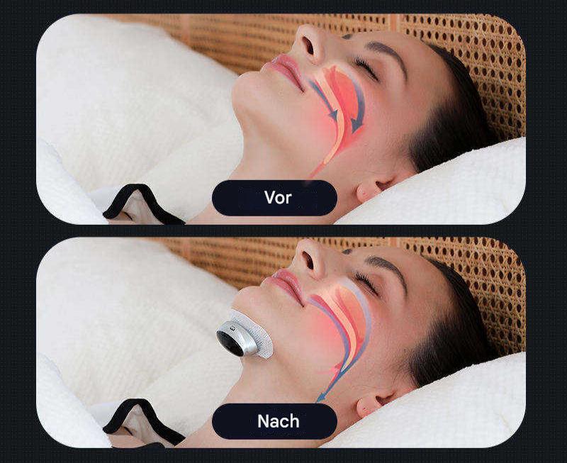 Dispositivo para la apnea del sueño