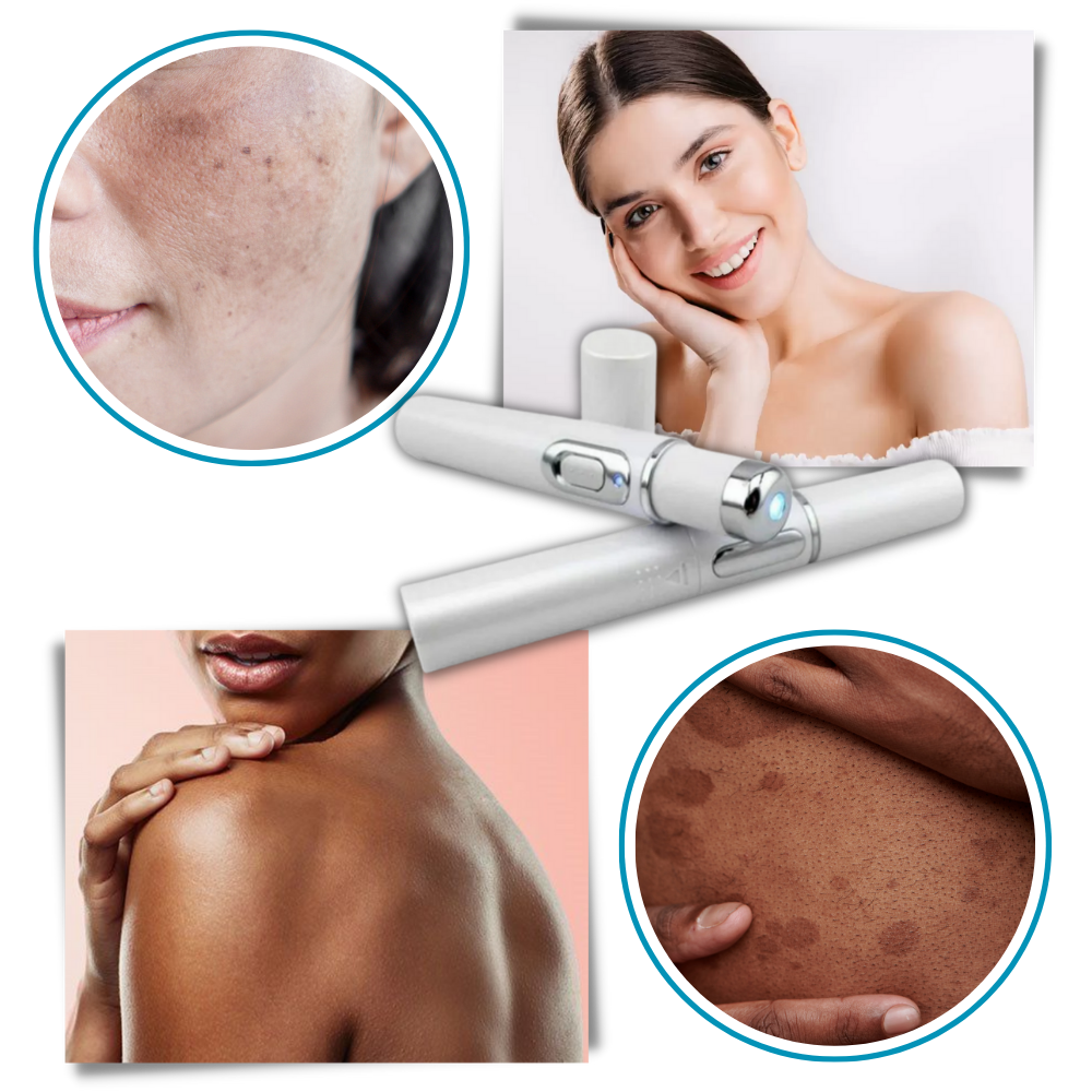 Lápiz Láser de Luz Azul para un Tono de Piel Más Claro