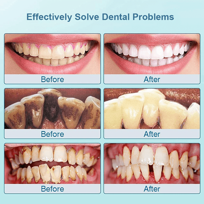 Limpiador y eliminador eléctrico ultrasónico de sarro dental